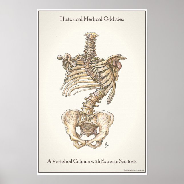 Scoliosis Spine Poster (Front)