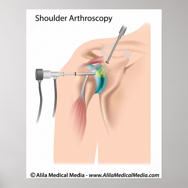 Shoulder arthroscopy diagram. poster (Front)