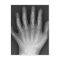 Six Fingered Hand, Medical Rarity, X-Ray