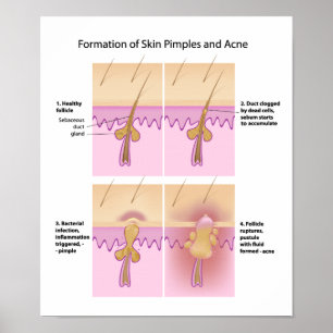 Skin Acne and pimples Poster