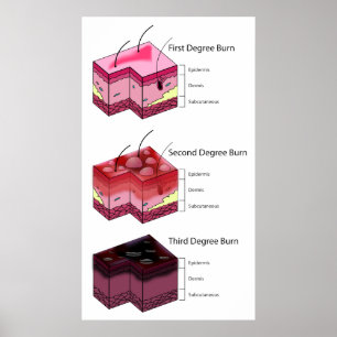 Skin Burn First Second & Third Degree Diagram Poster