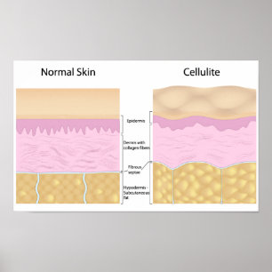 Skin cellulite  Poster