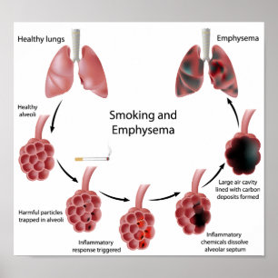 Smoking and emphysema Poster