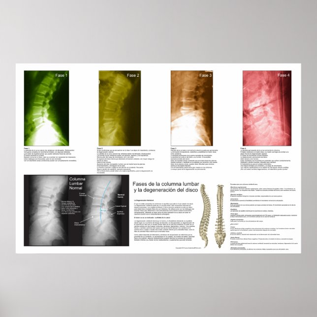 Spanish Phases Lumbar Spinal Degeneration Poster (Front)