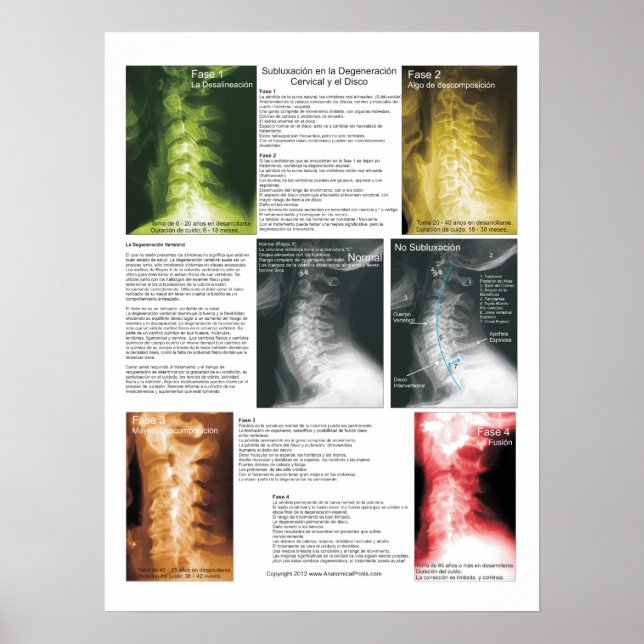 Spanish Subluxation Cervical Spinal Degeneration Poster (Front)