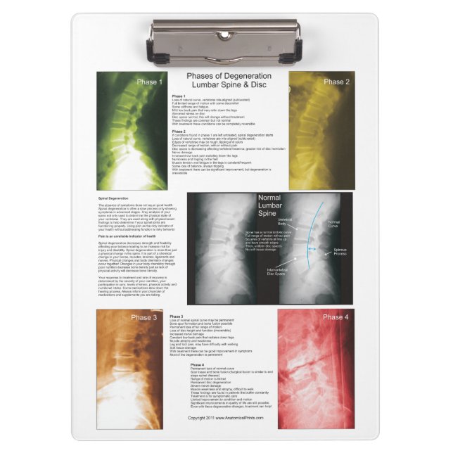 Spinal Degeneration Chiropractic Clipboard (Front)