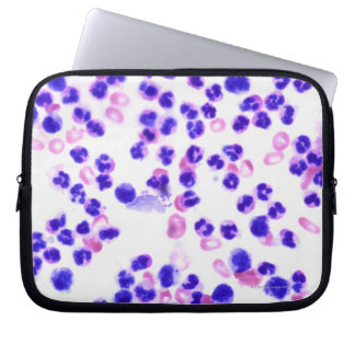 Staph Infection Laptop Sleeve
