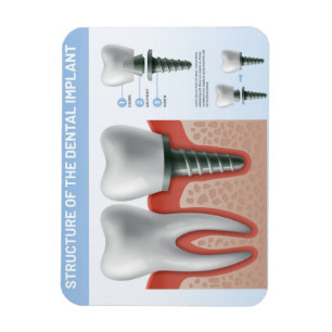 Structure of the Dental implant Magnet
