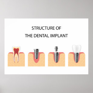 Structure of the dental implant poster