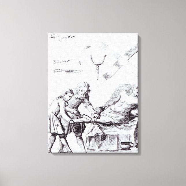 Surgical operation to amputate a leg canvas print (Front)