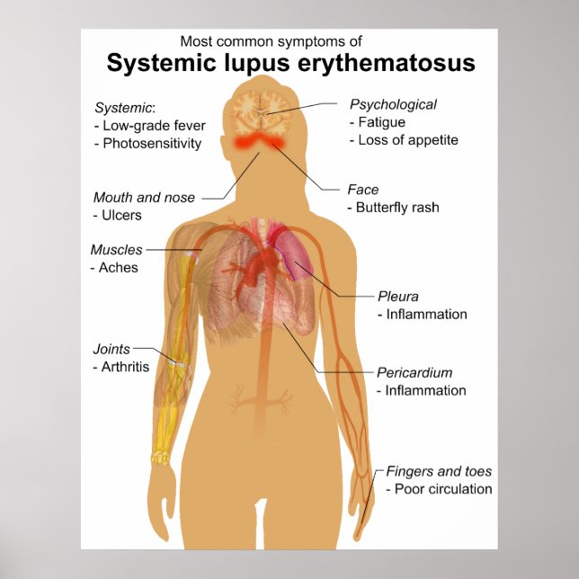 Symptom Chart of Systemic Lupus Erythematosus (Front)