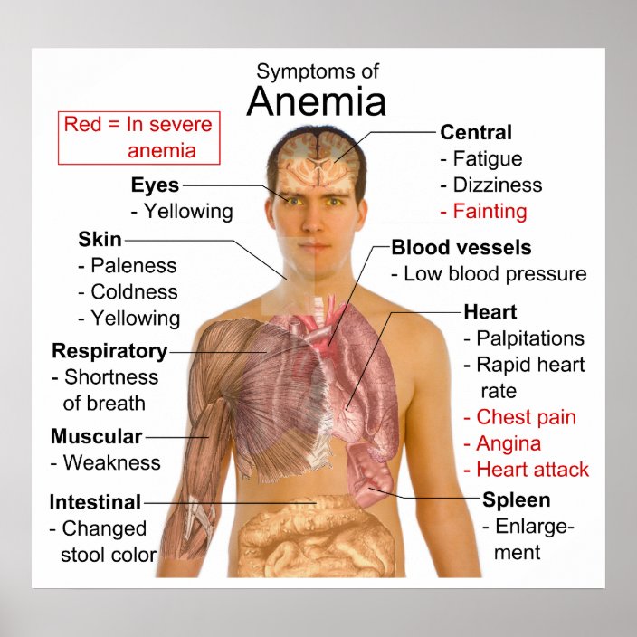 Symptoms Chart of the Blood Disease Anaemia Zazzle.co.nz