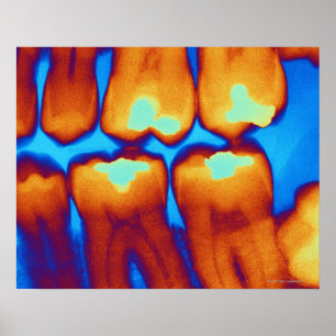 Teeth with fillings (green), colored X-ray. Poster