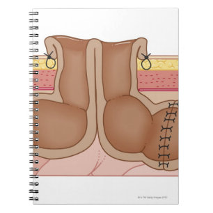 Temporary Colostomy Notebook