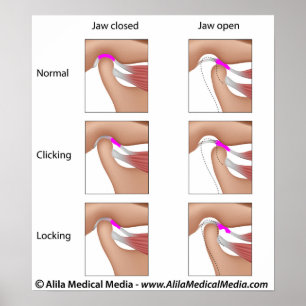 Temporomandibular joint dysfunction, TMJ or TMD Poster