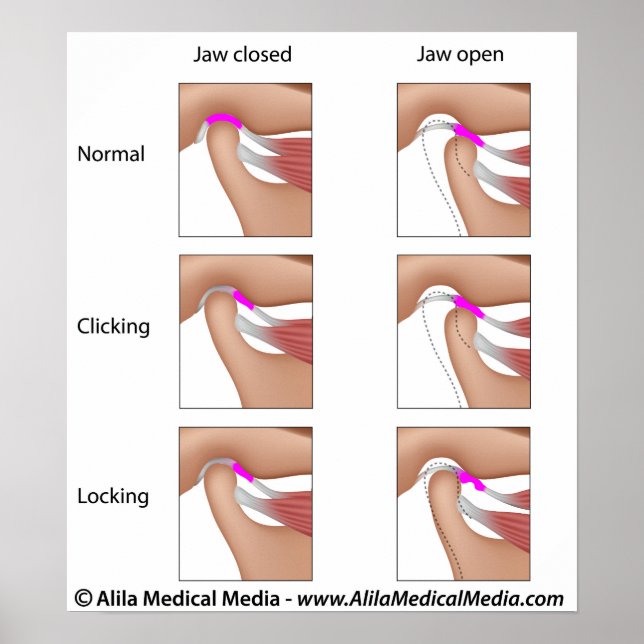 Temporomandibular joint dysfunction, TMJ or TMD Poster (Front)