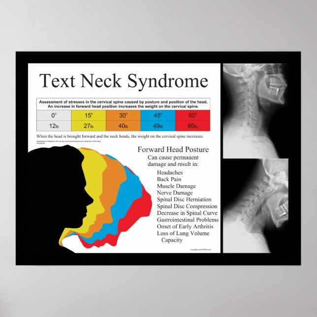 Text Neck Syndrome Chiropractic Poster (Front)