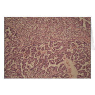 Thyroid gland cells with cancer