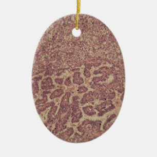Thyroid gland cells with cancer ceramic tree decoration