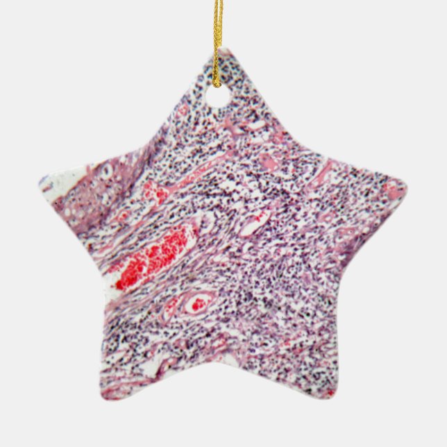 Tissue cells from a human cervix with cancer ceramic tree decoration (Front)