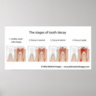 Tooth decay Poster