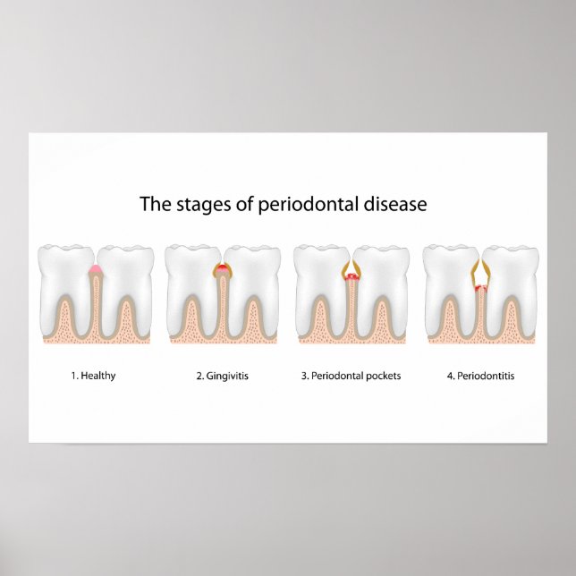 Tooth Periodontal Disease Poster (Front)