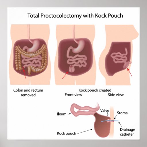 Total proctocolectomy with Kock pouch poster | Zazzle