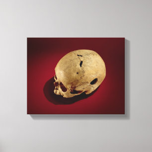 Trepanned Skull Canvas Print