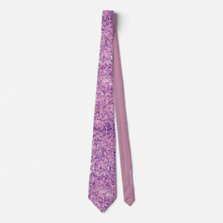 Uveal melanoma mixed cell type tie