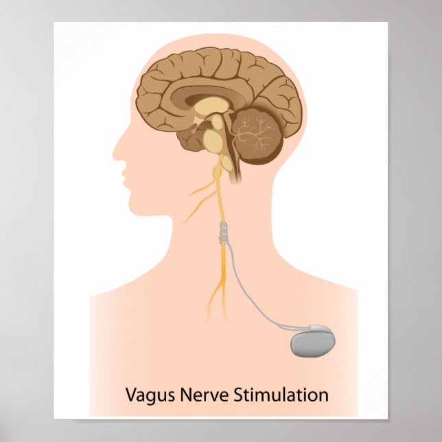 Vagus nerve stimulation therapy Poster (Front)