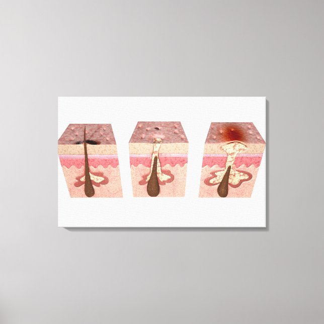 View of what causes acne canvas print (Front)