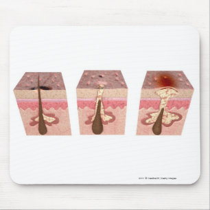 View of what causes acne mouse pad