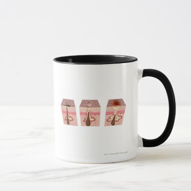 View of what causes acne mug (Right)