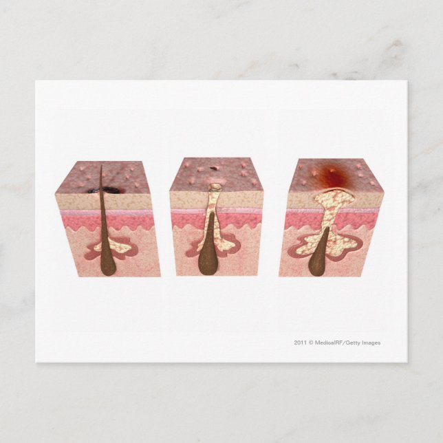 View of what causes acne postcard (Front)