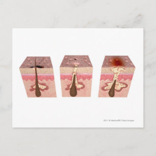 View of what causes acne postcard