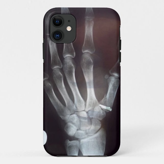 X Ray Hand Phone Case (Back)