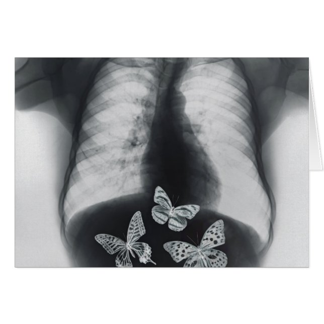 X-ray of butterflies in the stomach (Front Horizontal)