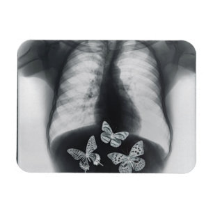 X-ray of butterflies in the stomach magnet