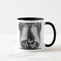 X-ray of butterflies in the stomach