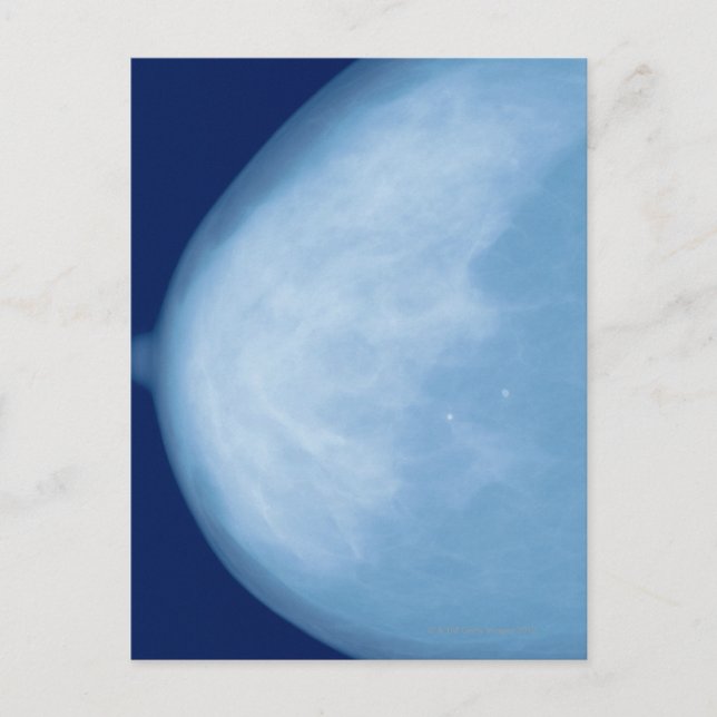 X-ray of female breast, side view postcard (Front)