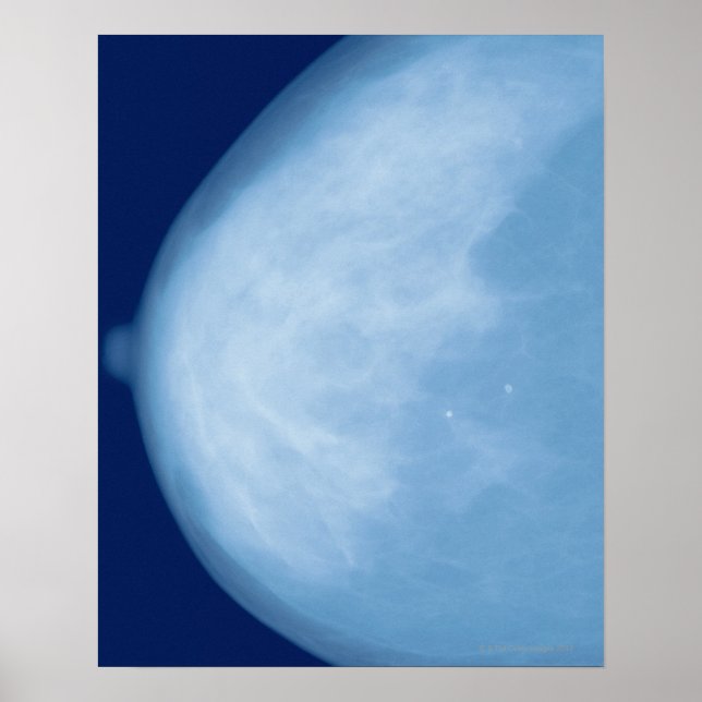 X-ray of female breast, side view poster (Front)