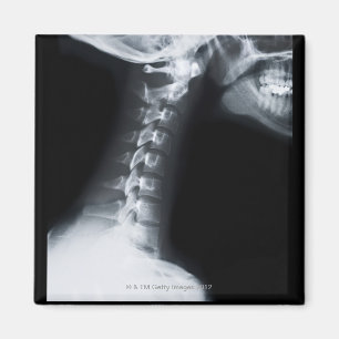 X ray of neck vertebrae including lower jaw magnet